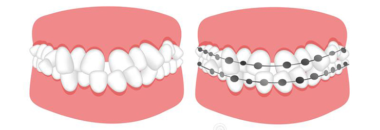 tratamiento de la maloclusión dental