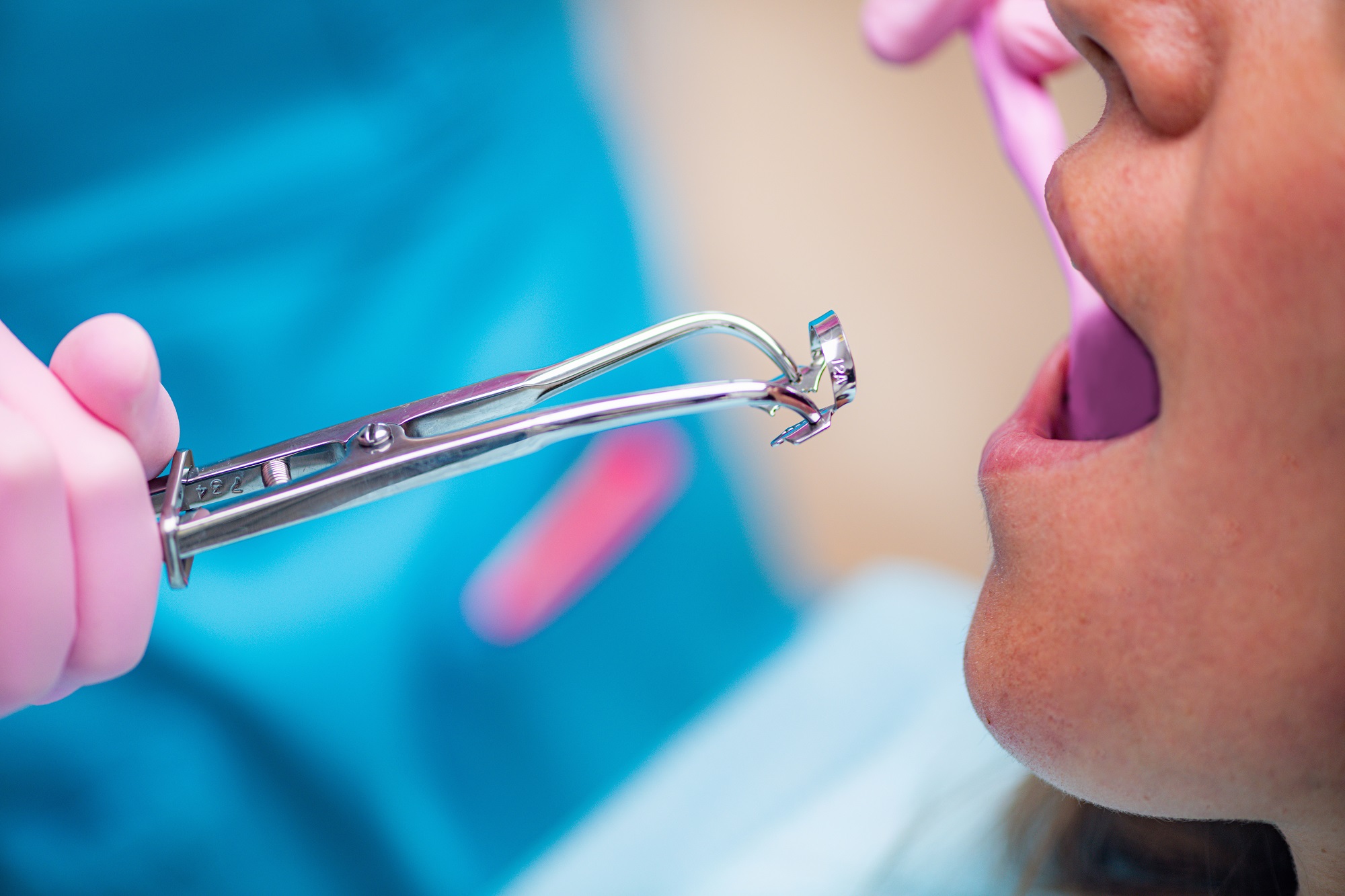 endodoncia multiradicular